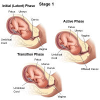 Stage 1 of labor