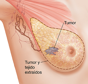 Vista de tres cuartos de la zona de una axila femenina donde puede verse la anatomía del seno en imagen fantasma. Se ve el contorno alrededor del tejido para una mastectomía simple.