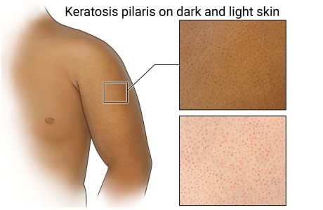 Keratosis pilaris on the upper arm, with details of how the small bumps appear on dark and light skin.