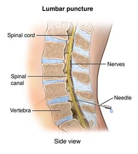 Side view cross-section of lumbar spine showing lumbar puncture.