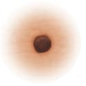 Normal mole that is symmetrical and has one color and smooth edge.